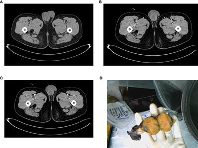 Alveolar rhabdomyosarcoma of epididymis: A case report